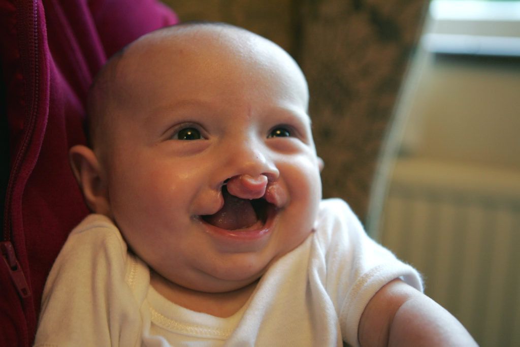 Cleft Lip & Palate Association