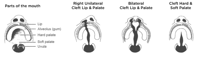 A diagram showing different varieties of cleft lip and palate