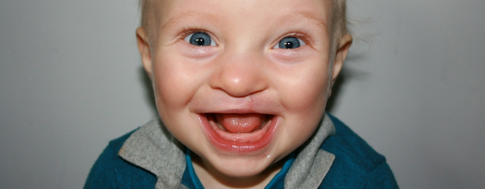 Boy with repaired cleft lip at 10 months old