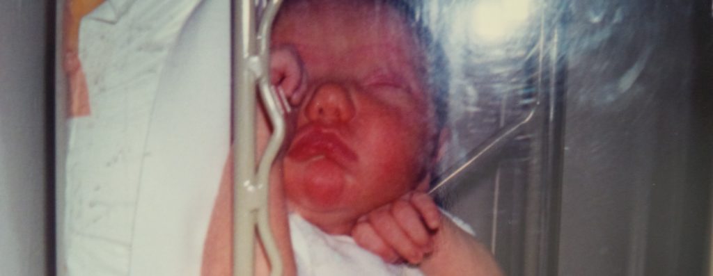 A baby with Van Der Woude Syndrome