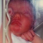 A baby with Van Der Woude Syndrome