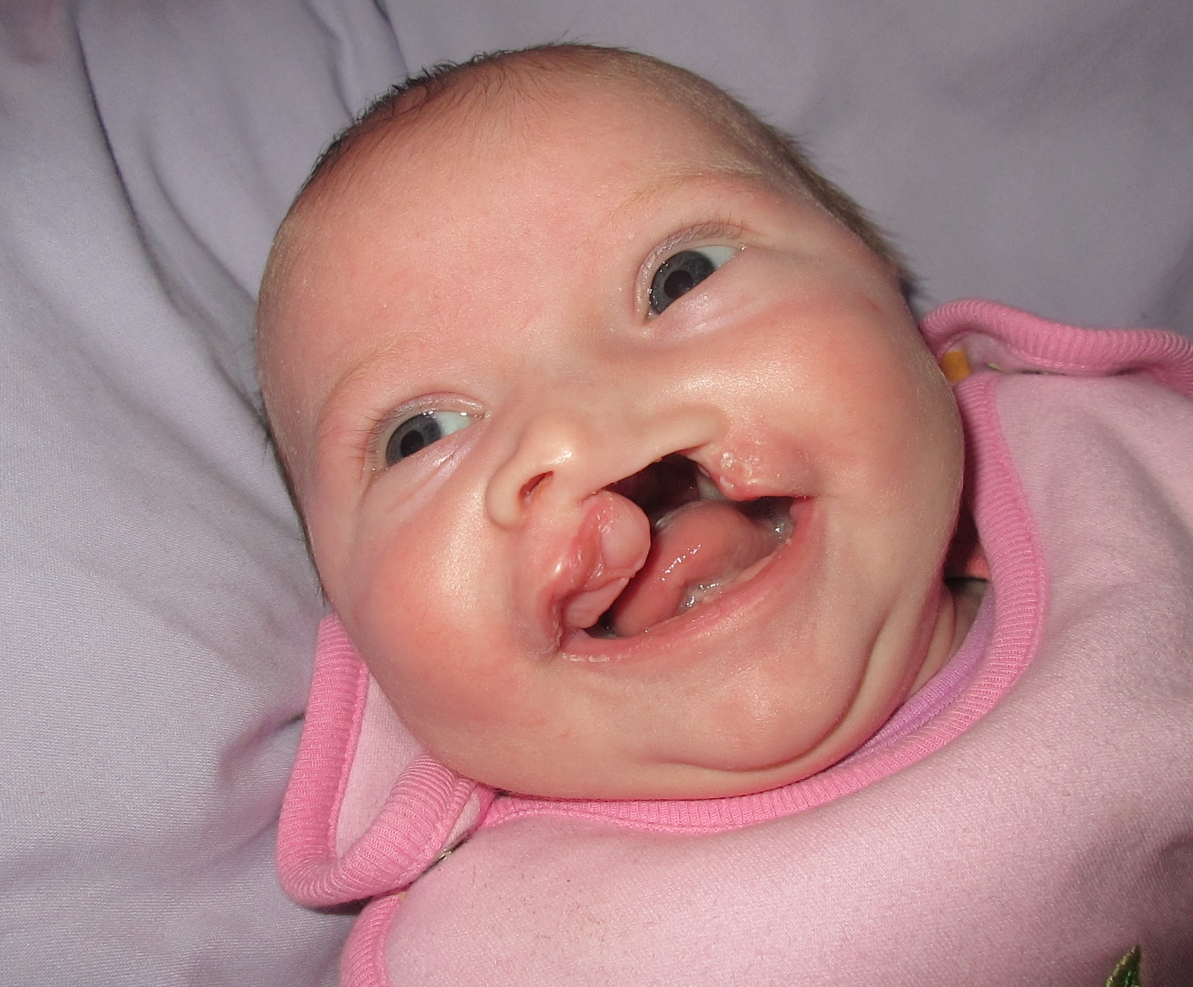 Les races à nez fendu Cleft-lip-and-palate-lily-5-weeks