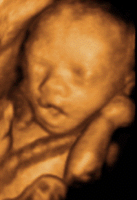 cleft lip 3d ultrasound