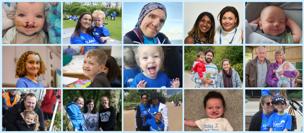 Chances of cleft lip picture