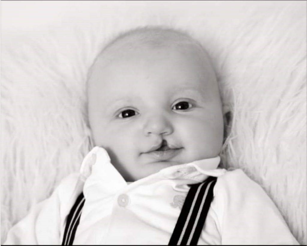 Black and white photo of a baby with a unilateral cleft lip, flying on a furry blanket and wearing a white shirt and suspenders.