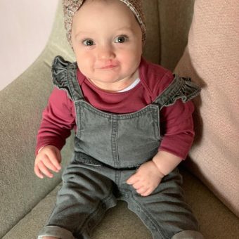 A baby with a faint scar by her lip is sitting up on a chair wearing dungarees and a headband