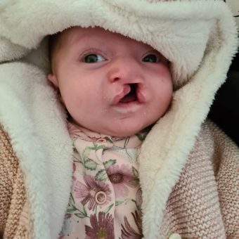 A baby with a unilateral cleft lip looks at the camera and wears a fluffy hood