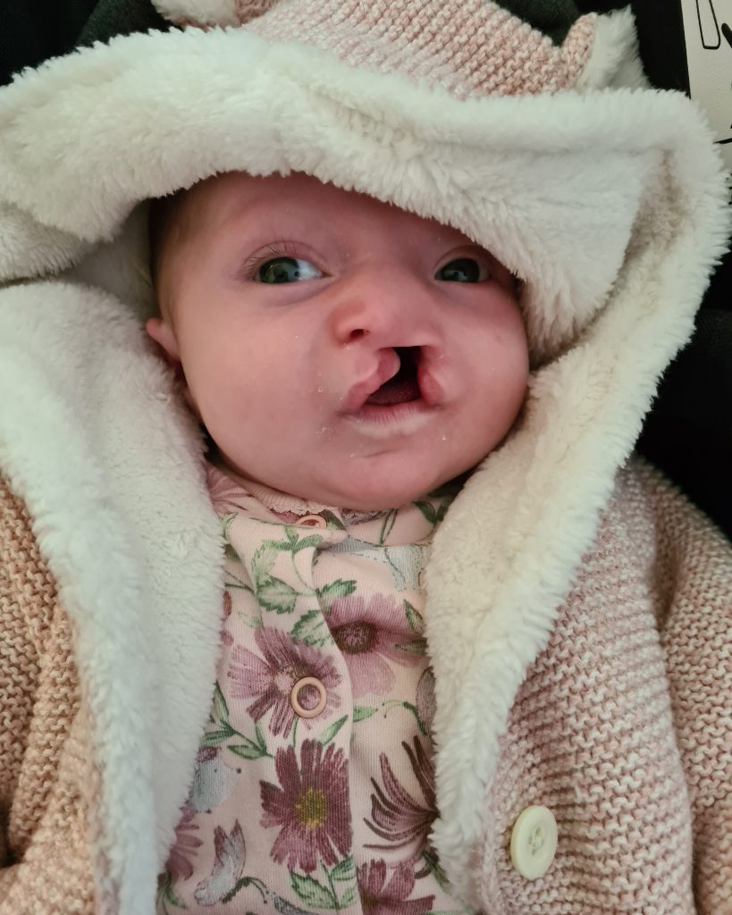 A baby with a unilateral cleft lip looks at the camera and wears a fluffy hood