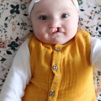 A baby with a unilateral cleft lip is lying down and looking up at the camera, wearing a headband and a yellow dress