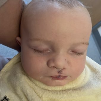 A baby with their eyes closed has stitches above their lip