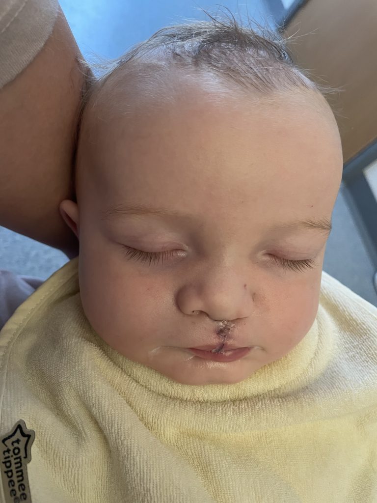 A baby with their eyes closed has stitches above their lip