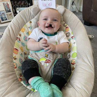 A baby with a cleft lip is smiling at the camera, sitting in a baby seat