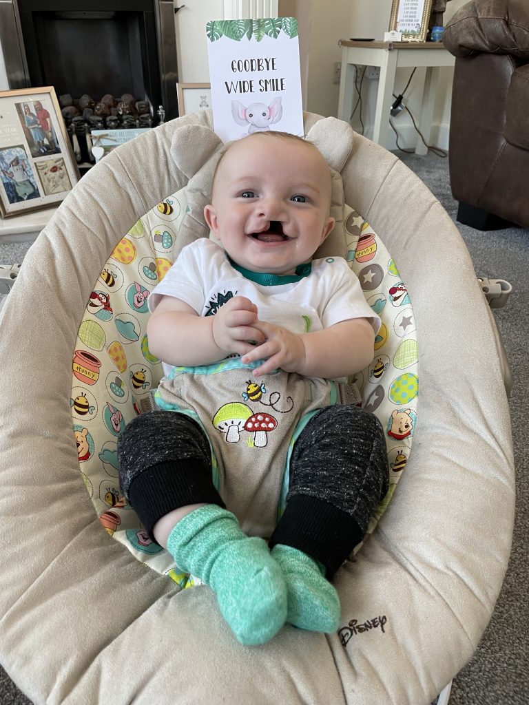 A baby with a cleft lip is smiling at the camera, sitting in a baby seat