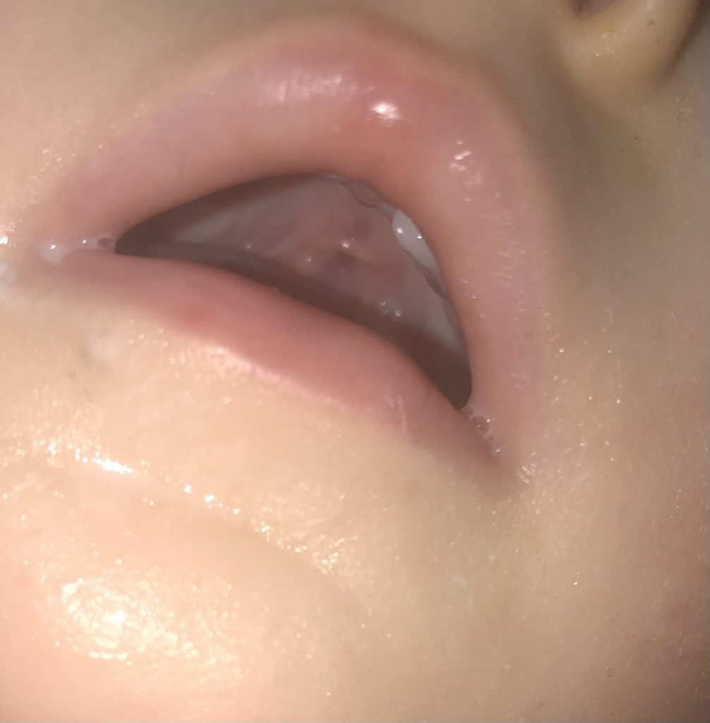 A close up photo of a baby's mouth showing their healed palate post repair surgery