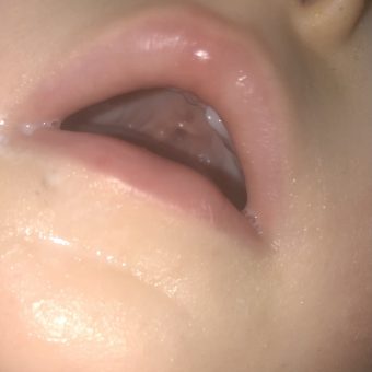 A close up photo of a baby's mouth showing their healed palate post repair surgery
