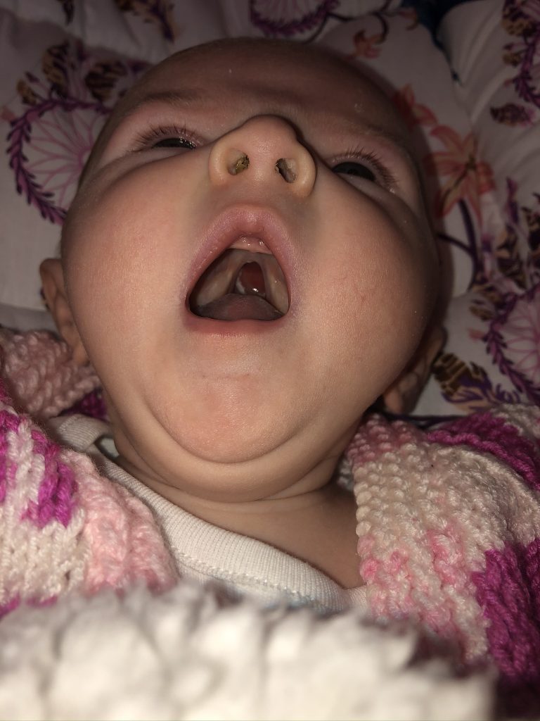 A baby lying down with their mouth open, showing their cleft palate