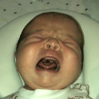 A baby crying, showing their cleft palate