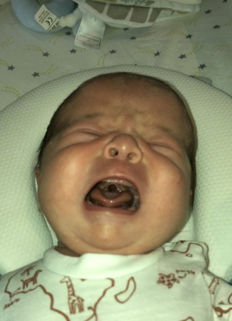 A baby crying, showing their cleft palate