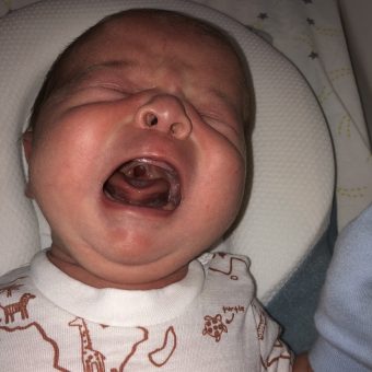 A baby crying, showing their cleft palate