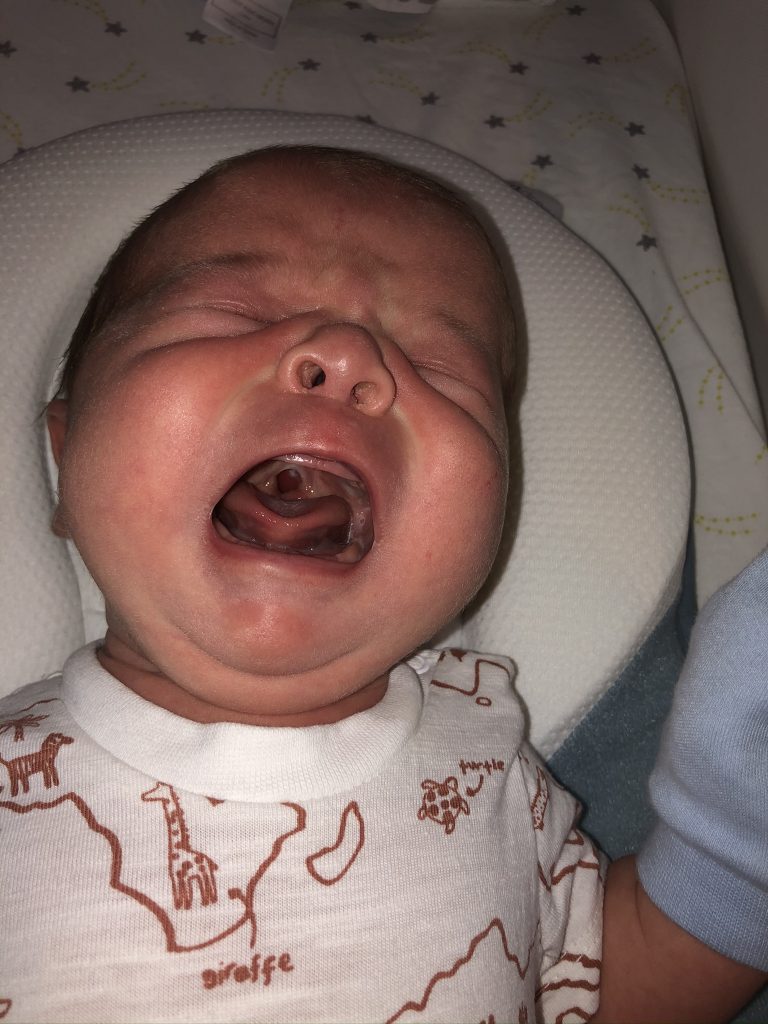 A baby crying, showing their cleft palate