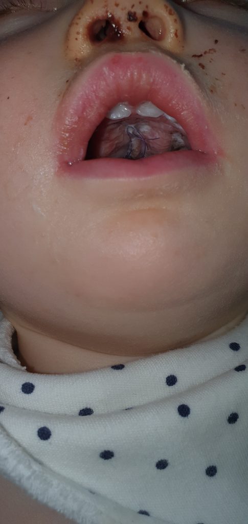 A baby's mouth post surgery, showing a bit of blood by their nose