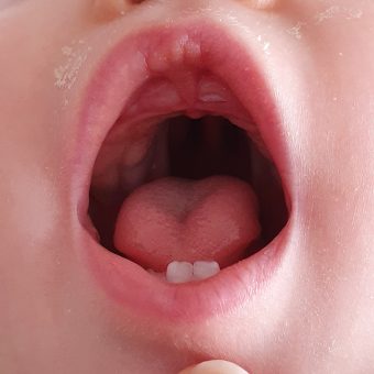 A view inside a baby's mouth, showing their cleft palate