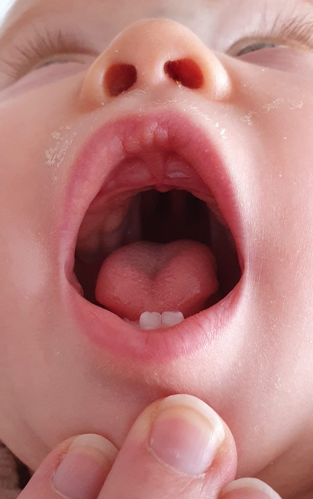 A view inside a baby's mouth, showing their cleft palate