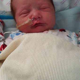 A baby lying down asleep with a feeding tube in their nose