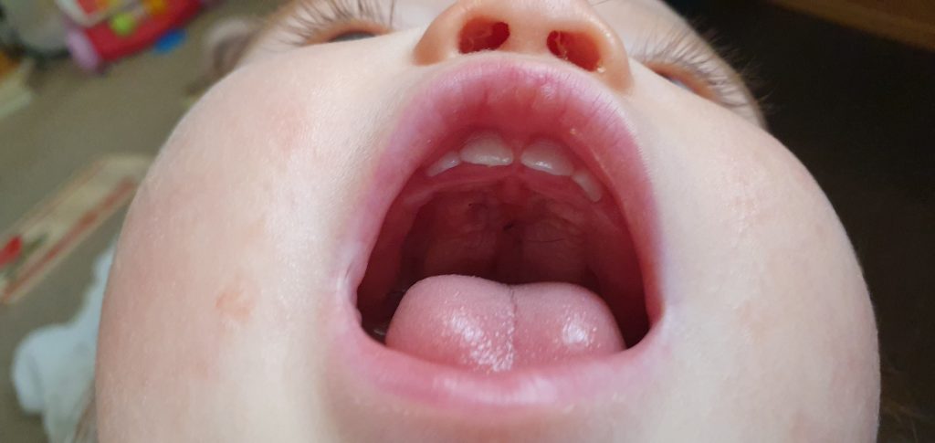 The inside view of a baby's mouth showing a healed palate after surgery