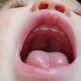 The inside view of a baby's mouth showing a healed palate after surgery