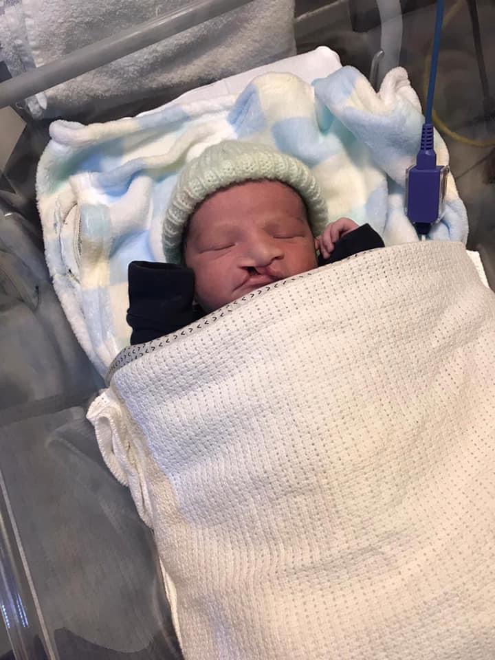 A baby with a cleft lip lying asleep in a hospital under a blanket