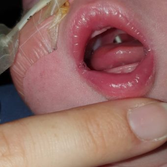 A photo of a baby's mouth, showing their cleft palate and feeding tube