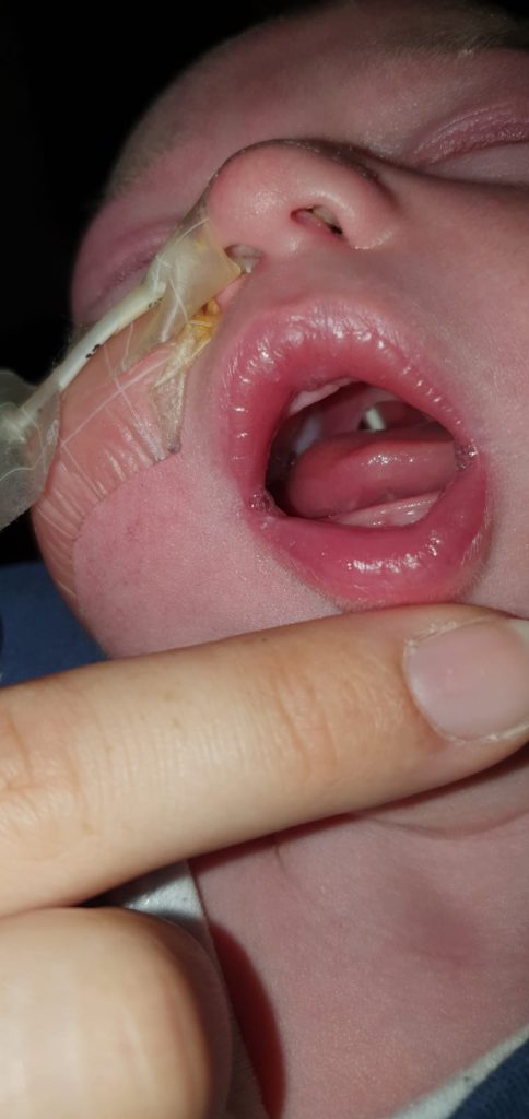 A photo of a baby's mouth, showing their cleft palate and feeding tube