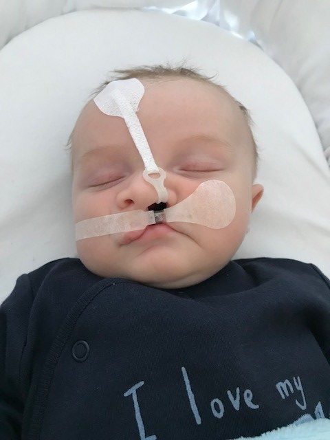 A baby with a cleft lip wearing cleft tape