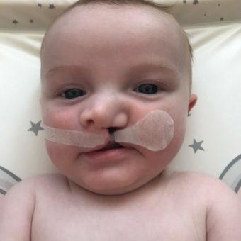 A baby with a cleft lip wearing cleft tape