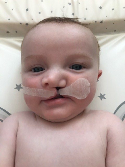 A baby with a cleft lip wearing cleft tape