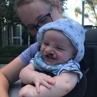 A woman holds a baby with a cleft lip who is wearing a sunhat and laughing