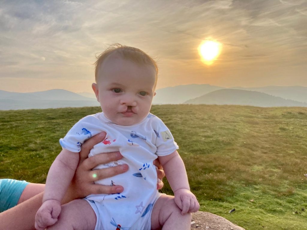 A baby with a cleft lip is being held up with mountains and a sunset in the background