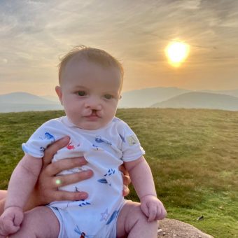 A baby with a cleft lip is being held up with mountains and a sunset in the background