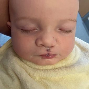 A baby sleeping with a scar above their lip