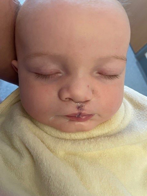 A baby sleeping with a scar above their lip