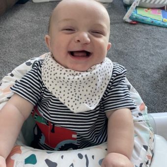 A baby post-op recovered and laughing