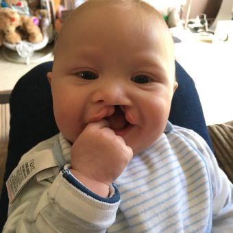 A baby born with a cleft sat in a high chair iwearing a blue and white striped top