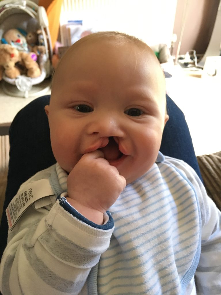 A baby born with a cleft sat in a high chair iwearing a blue and white striped top