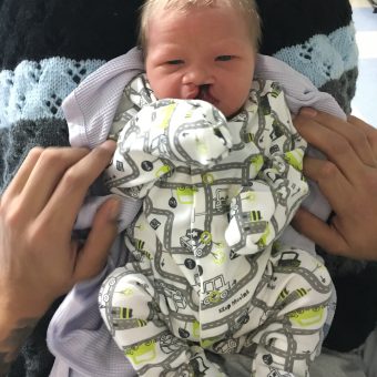 A new born baby with a cleft in a white, yellow and grey pattered baby grow